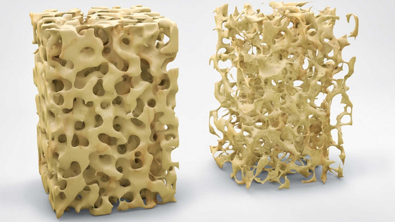 Ossa - Osteoporosi - MOC test