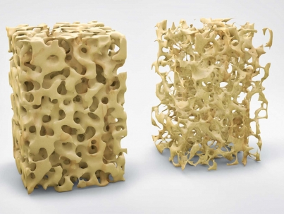 Ossa - Osteoporosi - MOC test